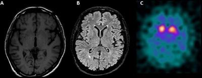 Long-Term Intravitreal Ranibizumab as a Potential Additional Risk Factor for Neurodegeneration in Parkinson’s Disease: A Case Report